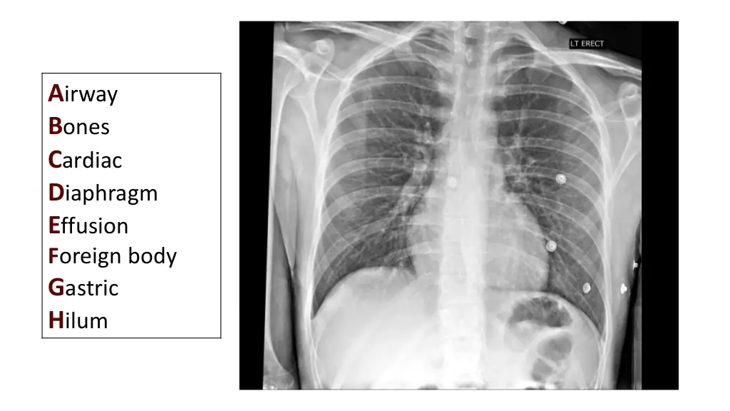 CXR ABC